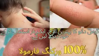 How to Cure Hot weather Pimples || Garmi Kay daano ka khatma .