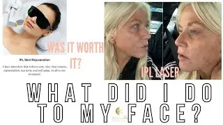REVIEW- IPL LASER REJUVENATION- RESULTS after 4 treatments- WORTH IT?  final reveal...