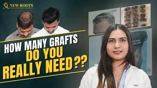 How Many Grafts Are Required for Hair Transplant? | Hair Transplant Grafts | New Roots