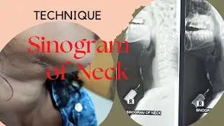 Technique sinogram of Neck (Ep-61) | X-ray  Of sinogram | Sinogram procedure | sonography