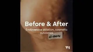 Varicose veins, endovenous ablation, before and after examples