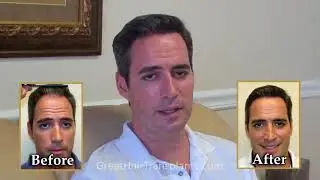 Dr. Brett Bolton Great Hair Transplant