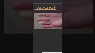 Raynaud’s Common Causes