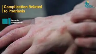 Dr. Surendra VHH – فهم الصدفية: الأسباب، الأنواع وخيارات العلاج | Apollo Hospitals