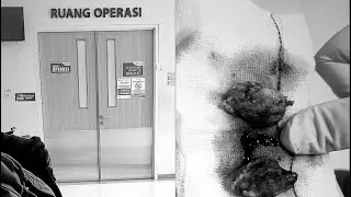 (Bagian 2 ) PENGALAMAN OPERASI AMANDEL #amandel #opamandel #tonsilsurgery #tonsil 