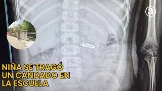 Ni&ntilde;a de tercer grado traga candado en la escuela y enfrenta posible cirug&iacute;a #candado #medicina
