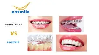 How Does Ensmile Work!