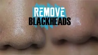 How To | Get Rid Of Blackheads INSTANTLY