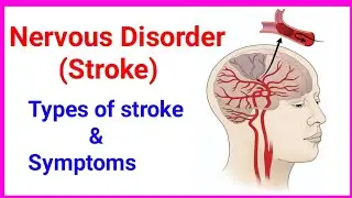 Aschemic, hemorrhagic and mini stroke/#stroke #brainstroke #nervousdisorder #neurologicaldisorders