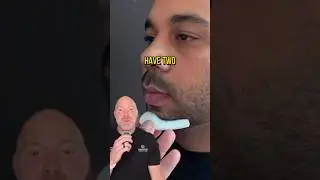 Chin Implant Completely Changed his Face 🤯