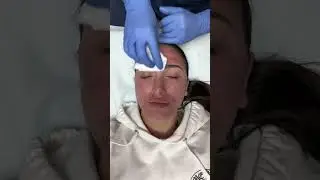 Come with me to get a Morpheus 8 treatment on my face! This is going to help tighten my skin, lighte