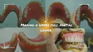making a Upper full partial lower denture (Dentaltech VLOG)