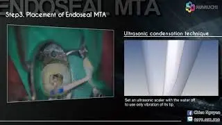 Endoseal
