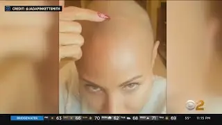 Doctors report uptick in alopecia patients coming forward for help