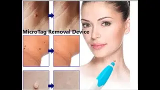 Auto Skin  Micro Skin Tag Removal Device Adult Mole Stain Wart Remover Face Care Beauty Tools