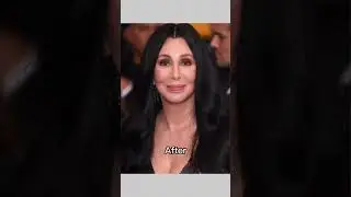 Cher (Cherilyn Sarkisian) Before and after