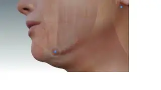 DermalTouch Aesthetics - Quantum RF10 Skin Tightening - Animation