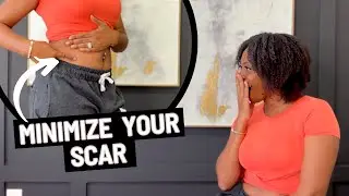 Secrets to Flawless Transplant Scar Care: Q&A with Tips & My Success Story