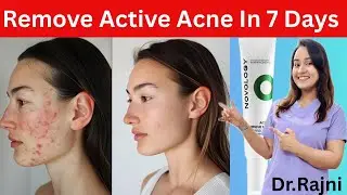 Remove Active Acne & Pimples In 7 Days | Novology Acne Rescue Spot Corrector Cream Review |#novology
