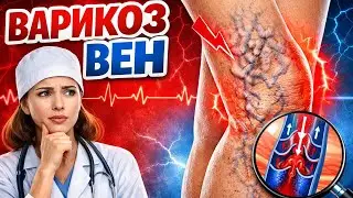 Варикоз без мифов: что на самом деле происходит с венами и как это лечить?!