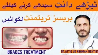 &ldquo;Braces Treatment Full Guide | Crooked TeethFix | Before & After Results | Complete Orthodontic 
