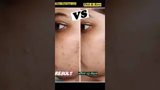 Dot & Key VS The Derma Co || #shorts #comparison #ashortaday #honestreview