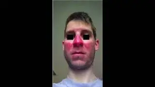 Sunburn fails