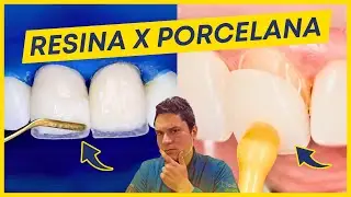 FACETAS EM RESINA X PORCELANA: QUAL A MELHOR? (A VERDADE)