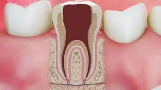 ROOT CANAL