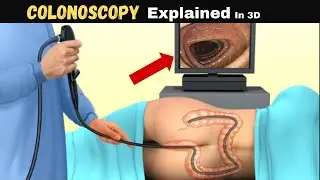Colonoscopy Explained: What You Need to Know About Your Colon Health&rdquo;