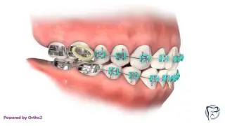 Class III Elastics
