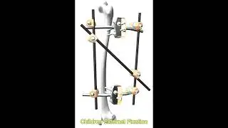 externalfixation|😊The display of Children External Fixation|orthopedics|medical|bone|trauma