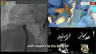 Live TTVR in Secondary TR with EVOQUE: Step-by-Step Deployment at University Medical Center Mainz
