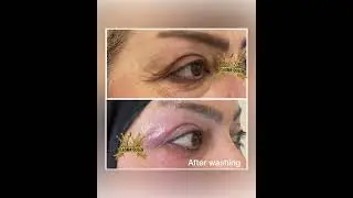 #shortsvideo #shortvideo #fibroblast #plasma #eyelift