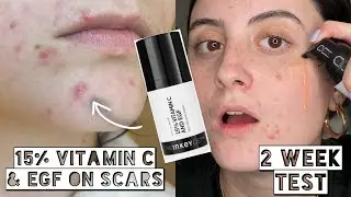 TESTING The Inkey LIST 15% Vitamin C & EGF on Acne Scars & Dry, Sensitive Skin for 2 Weeks!!