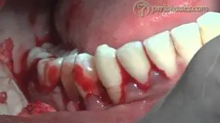 Modified flap operation