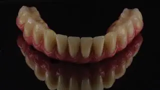 Before & After Dental Implant Treatment At Brighton Implant Clinic