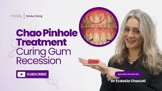 Frequently Asked Questions on Revolutionary Pinhole&reg; For Gum Recession by Dr Evdokia Chasioti