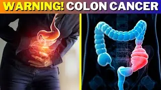 Top 7 COLON CANCER Warning Signs That Should Not Be IGNORED