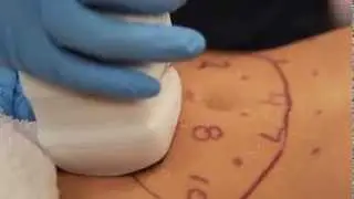 Liposonix&reg; Procedure Abdomen