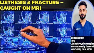 Listhesis and Vertebral Fracture on MRI | Complete Explanation