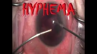 How to: Hyphema Washout