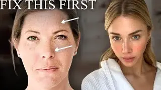You&rsquo;re Ignoring These Game-Changing Filler Spots | Temples, Forehead & the Nose Explained