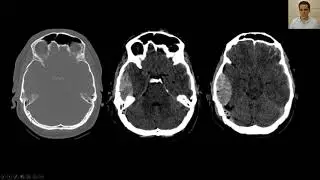 Hematoma Epidural: tudo o que você precisa saber na imagem