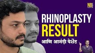 MIND-BLOWING Rhinoplasty Secrets Revealed