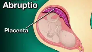 Problems with Delivery (Pregnancy Health Guru)