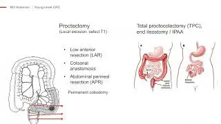 Y. Nancy You, MD discusses 