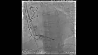 Abnormally Enlarged Singular Thebesian Vein in Right Atrium