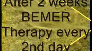 Liver Disease success with BEMER 3000