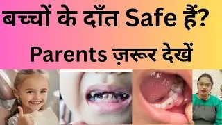 बच्चों के दाँतों में कैविटी? माता-पिता ज़रूर जानें!&ldquo;Cavity in Children&rsquo;s Teeth | 